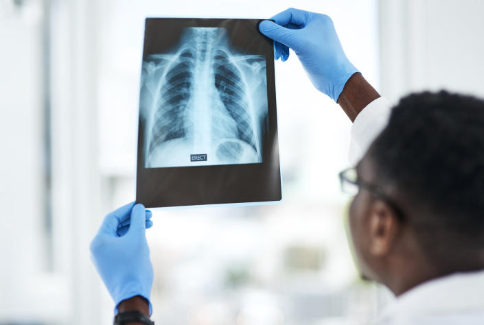 An African American technician in blue gloves shows an x-ray of a human chest.